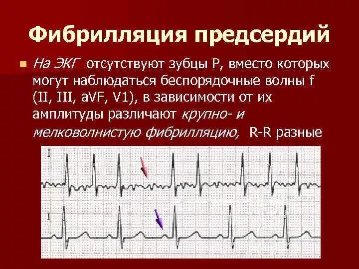 Тахисистолия это. Фибрилляция желудочков на ЭКГ. Фибрилляция предсердий и желудочков на ЭКГ. Фибрилляция предсердий Мерцательная аритмия ЭКГ. Трепетание предсердий и желудочков на ЭКГ.