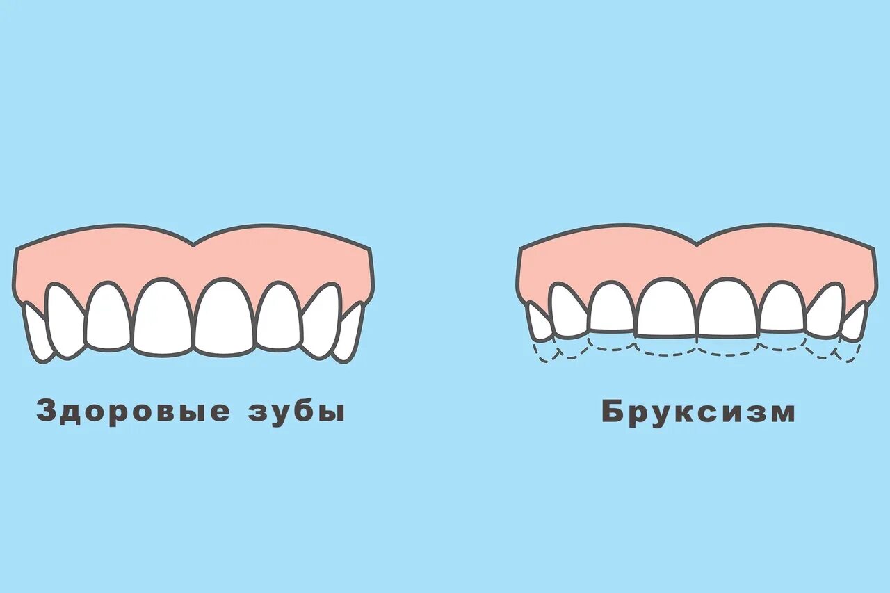 Зубы стучат что значит. Essix ретейнер. Бруксизм наращивание зубов.