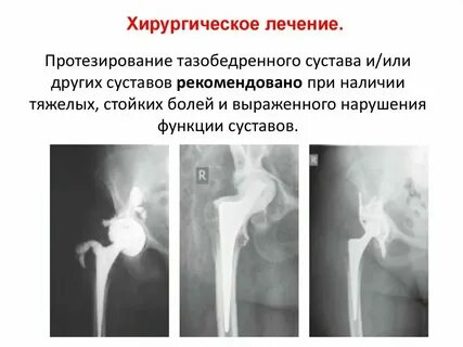 Перипротезная инфекция тазобедренного сустава