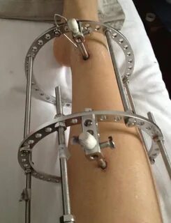 Зачем при переломах спицы