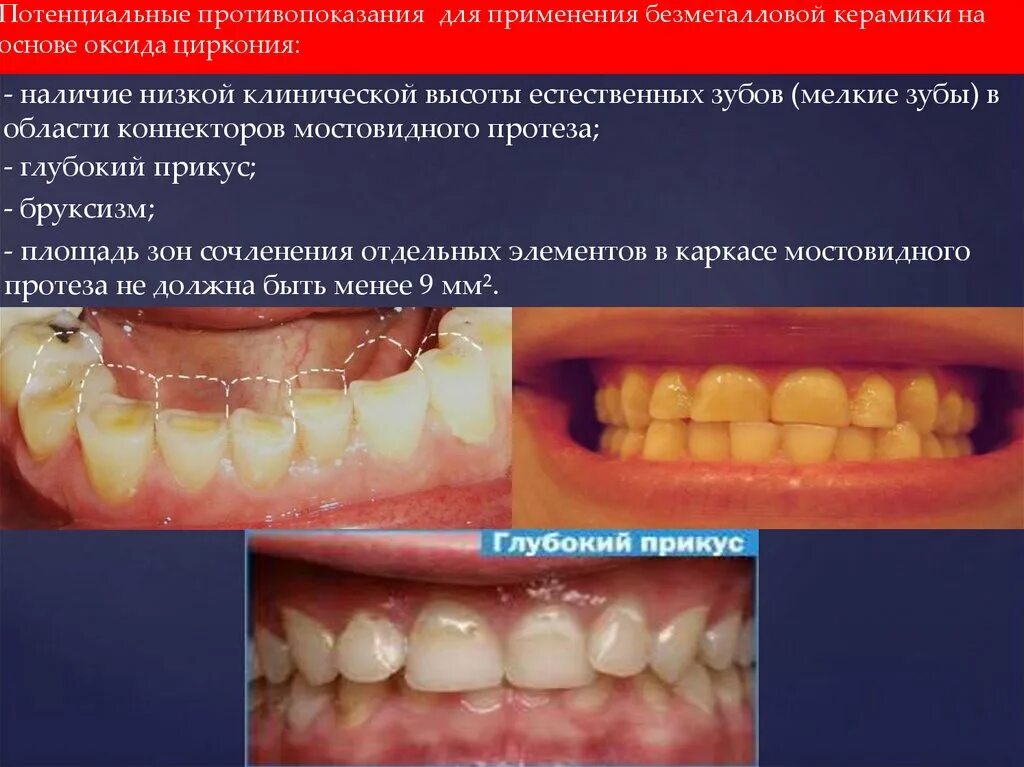 Типы реставраций. Эстетико-функциональное восстановление зуба. Цель реставрации зубов. Эстетическая реставрация.