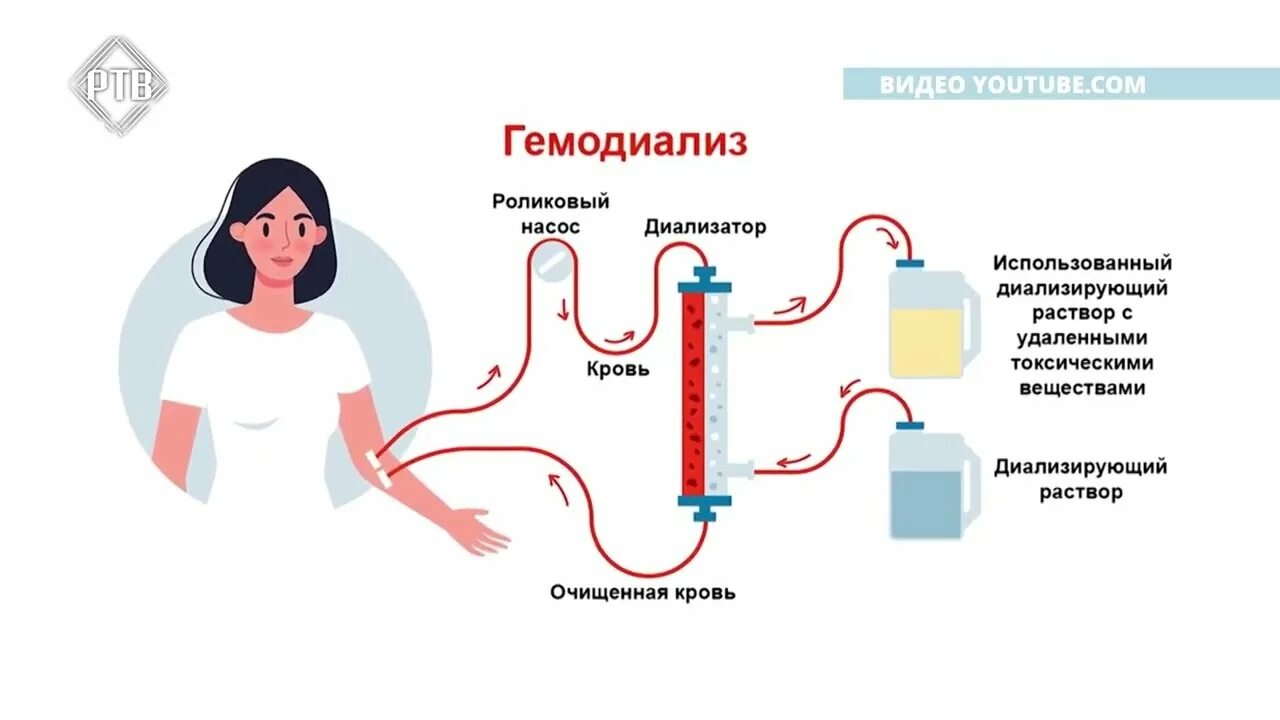 Диализ операция. Диализ операция