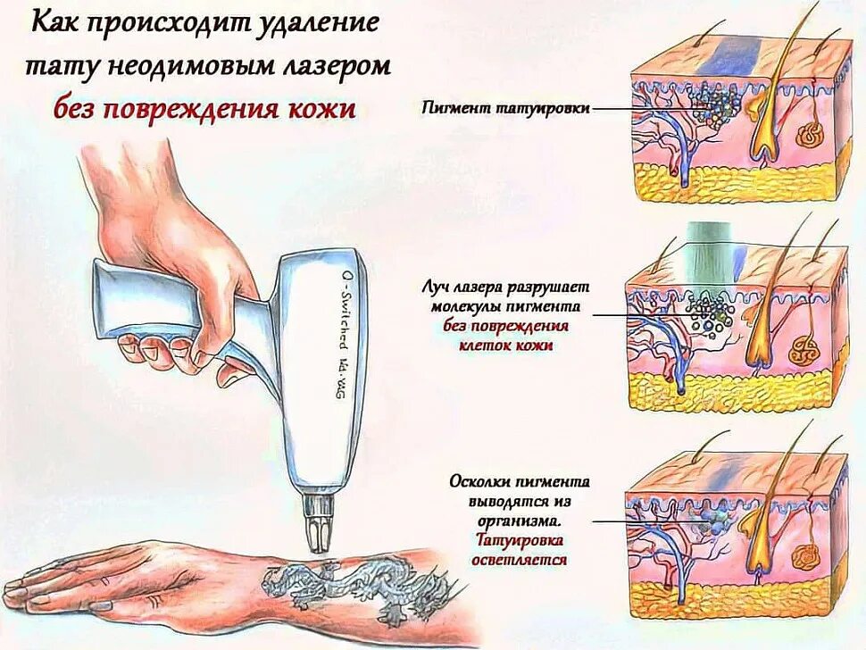 Разрушение пигментов. Принцип удаления тату лазером. Удаление татуировок неодимовым лазером. Удаление тату неодимовым лазером. Принцип удаления Татуировки лазером.