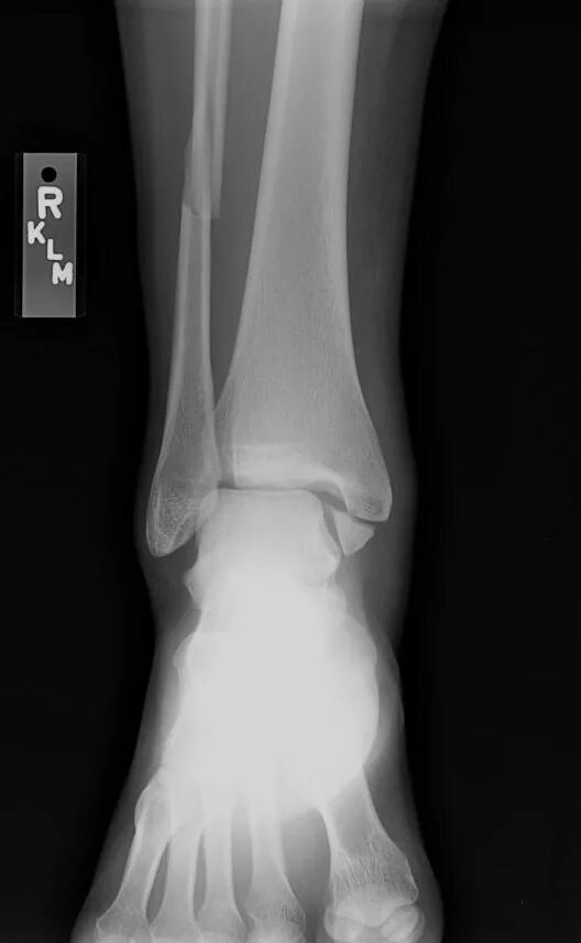 Как выглядит трещина на ноге голеностоп Rehabilitation after an ankle fracture with the methods of Chinese traditional m