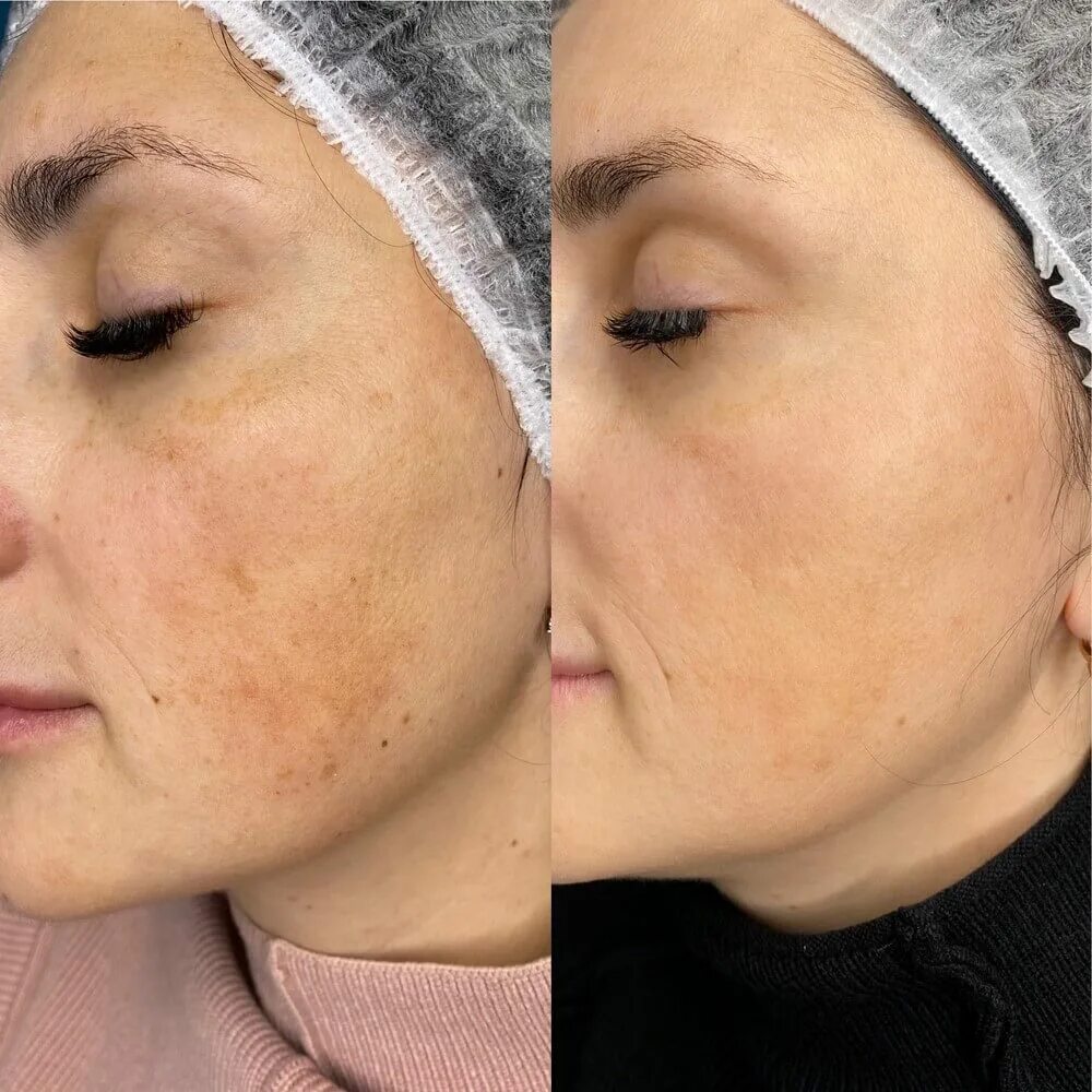 Лазеролечение розацеа. Лицо после м22. Лицо после м22. М22 фотоомоложение фототермолиз. Лицо после м22.