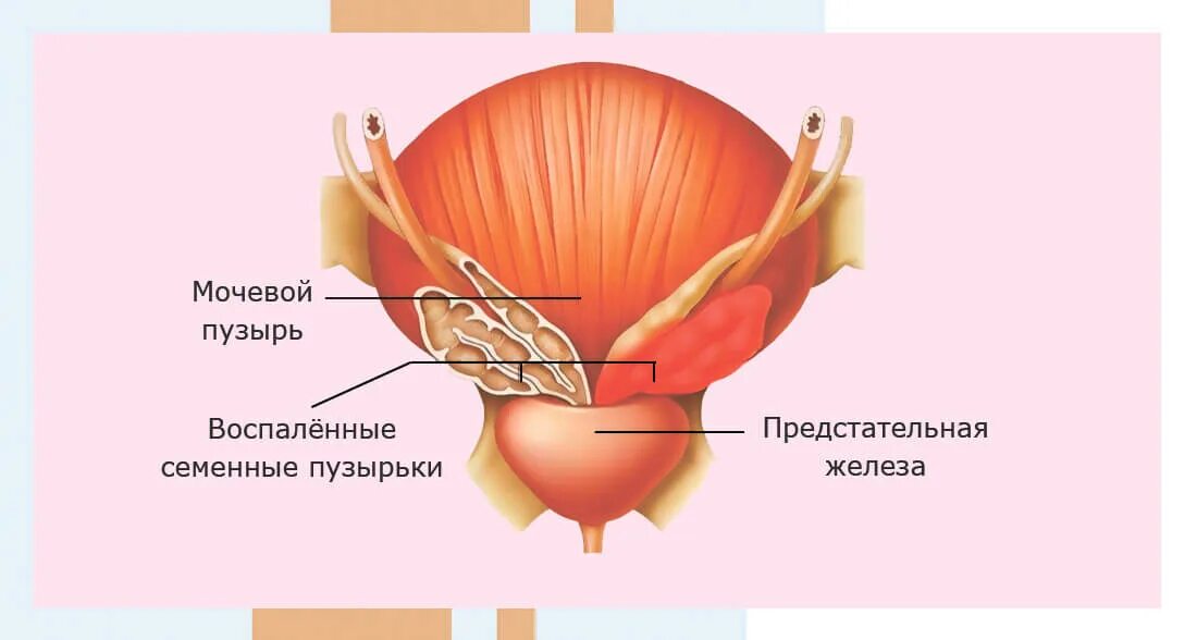 Воспаление семенного мужчин. Везикулит у мужчин симптомы. Везикулит сперматоцистит.