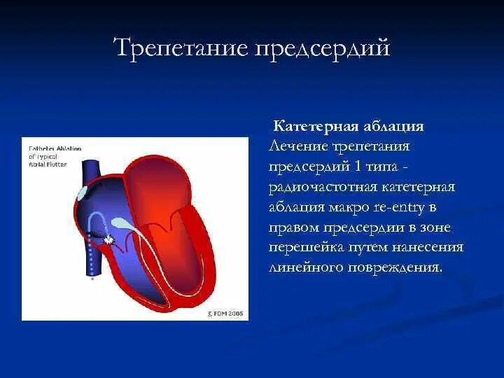 Проводящая система сердца. РЧА трепетания предсердий. Нарушение функции предсердия. Движение крови из предсердия в желудочек регулируют. Левое предсердие увеличено