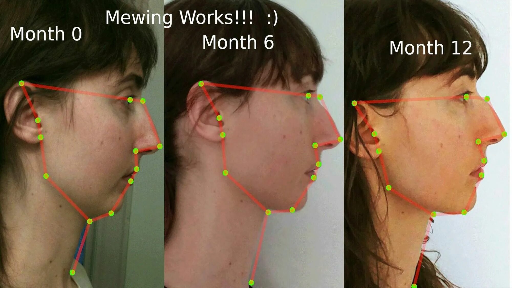 Максилла Мьюинг. Mewing до и после. Коррекция подбородка. Мьюинг упражнения для лица.