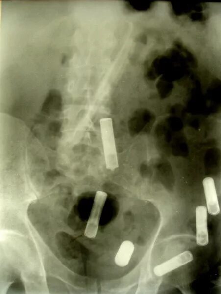 Инородное тело брюшной полости после операции. Инородные тела в прямой кишке рентген. Инородное тело в кишечнике рентген. Рентген брюшной полости инородное тело. Инородное тело в желудке рентген.