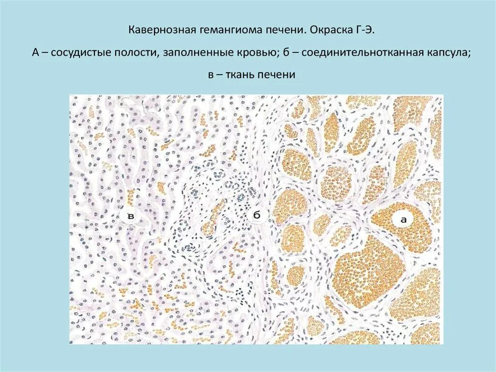 Печень микропрепарат описание. Кавернозная гемангиома печени микропрепарат. Капиллярная гемангиома печени макропрепарат. Кавернозная ангиома печени микропрепарат. Печень при механической желтухе микропрепарат.