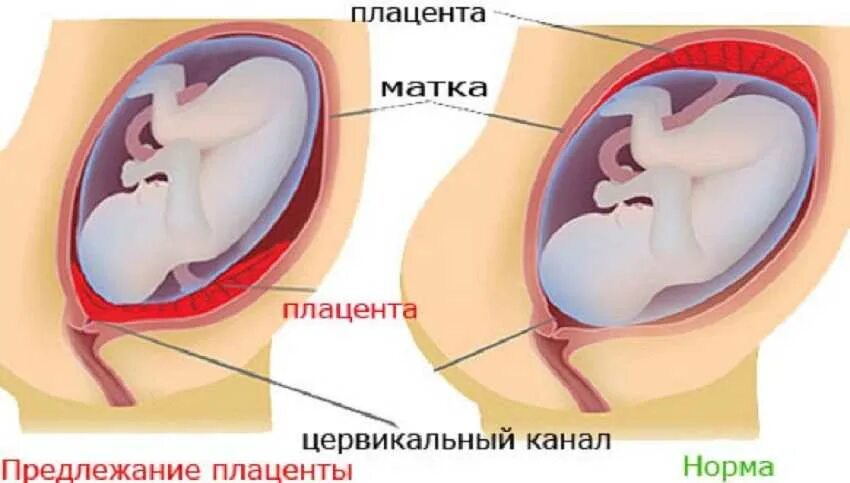 Предлежание плаценты. Низкое расположение плаценты. Шеечное предлежание плаценты. Предлежание плаценты и низкая плацентация. Ребенок расположен справа