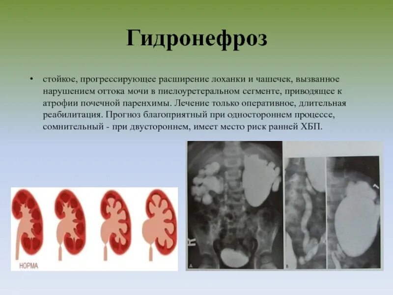 Расширение лоханки у ребенка. Врожденный гидронефроз симптомы. Атрофия паренхимы почек. Расширение чашечек и лоханки.