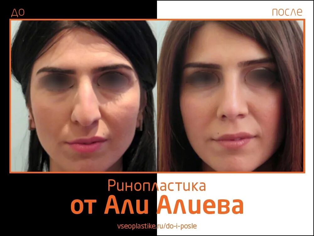 али алиев пластический хирург. сеймур алиев ринопластика. сеймур алиев ринопластика. алиев пластический хирург отзывы. неудачная пластика носа.