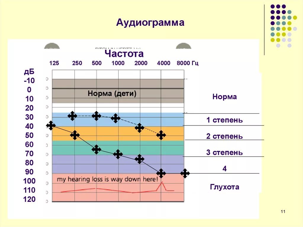 Тест на возраст по частоте звука. Аудиограмма 1 степени тугоухости. Аудиограмма слуха 3 степени. Аудиограмма слуха расшифровка таблица. Аудиометрия тугоухость 1 степени.