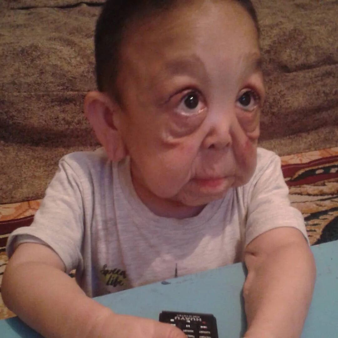 болезнь когда выглядишь как ребенок