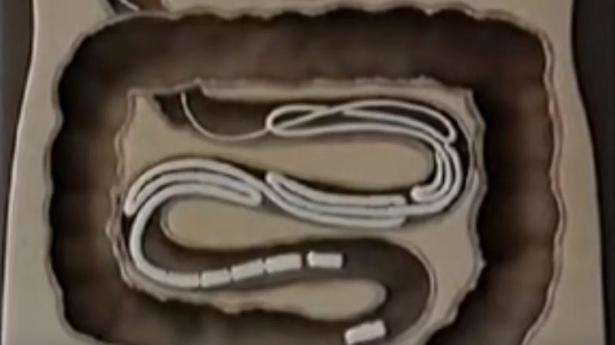 Глисты в таблетках для похудения. Тайские таблетки для похудения с червями. Девушка съела ленточного червя чтобы похудеть. Солитер червь ленточный. Девушка съела ленточного червя чтобы похудеть.