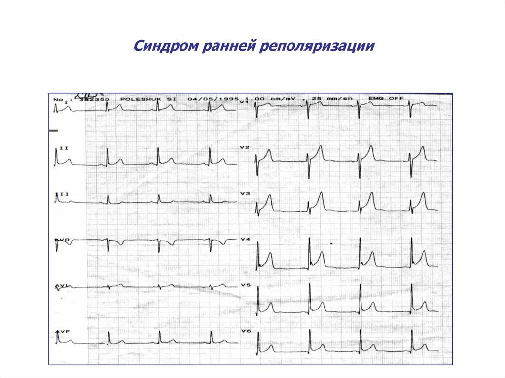 Ранняя реполяризация желудочков на ЭКГ. Синдром ранней реполяризации желудочков на ЭКГ. Ранняя реполяризация желудочков сердца на ЭКГ. ЭКГ феномен ранней реполяризации. Нарушение признаков реполяризации