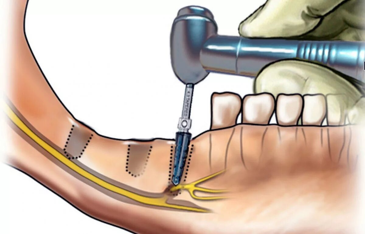 Восстановление нервов после операции. Дренаж стоматологический хирургический. Повреждение нижнечелюстного нерва.