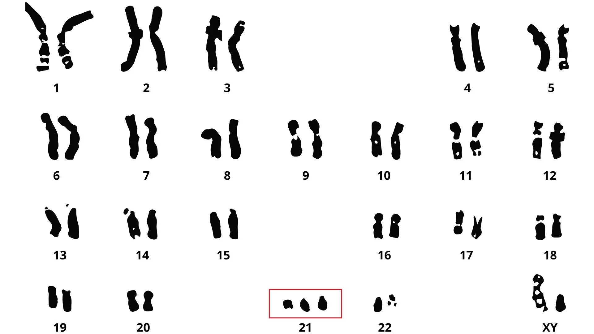 Изменение формы хромосом. Синдром Дауна трисомия 21 хромосомы. Синдром Дауна 47 хромосом. Набор хромосом при синдроме Дауна. Набор хромосом у человека с синдромом Дауна.