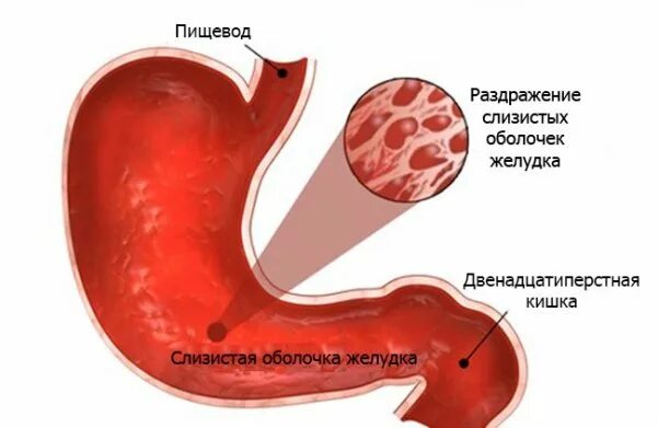 Раздражение слизистых оболочек желудка. Раздражение слизистой оболочки желудка. Раздражение слизистой оболочки ЖКТ. Эритематозная гастропатия что это простыми