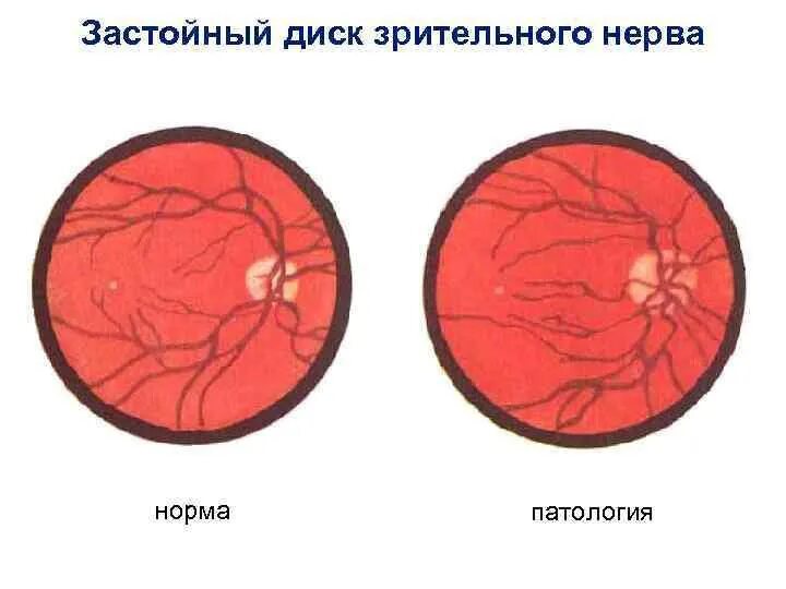 Норма зрительного нерва. Застойный диск зрительного нерва патогенез. Резко выраженный застойный диск зрительного нерва. Отек диска зрительного нерва клиника.