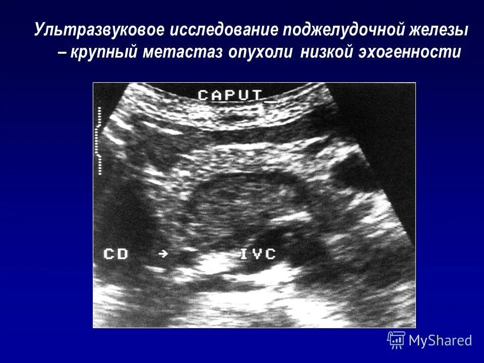 Злокачественная опухоль поджелудочной железы УЗИ. Опухоль поджелудочной железы на УЗИ. Ультразвуковое исследование поджелудочной железы. Фуци поджелудочной железы.