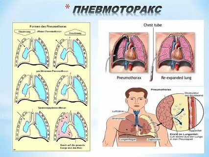 Открытый клапанный пневмоторакс