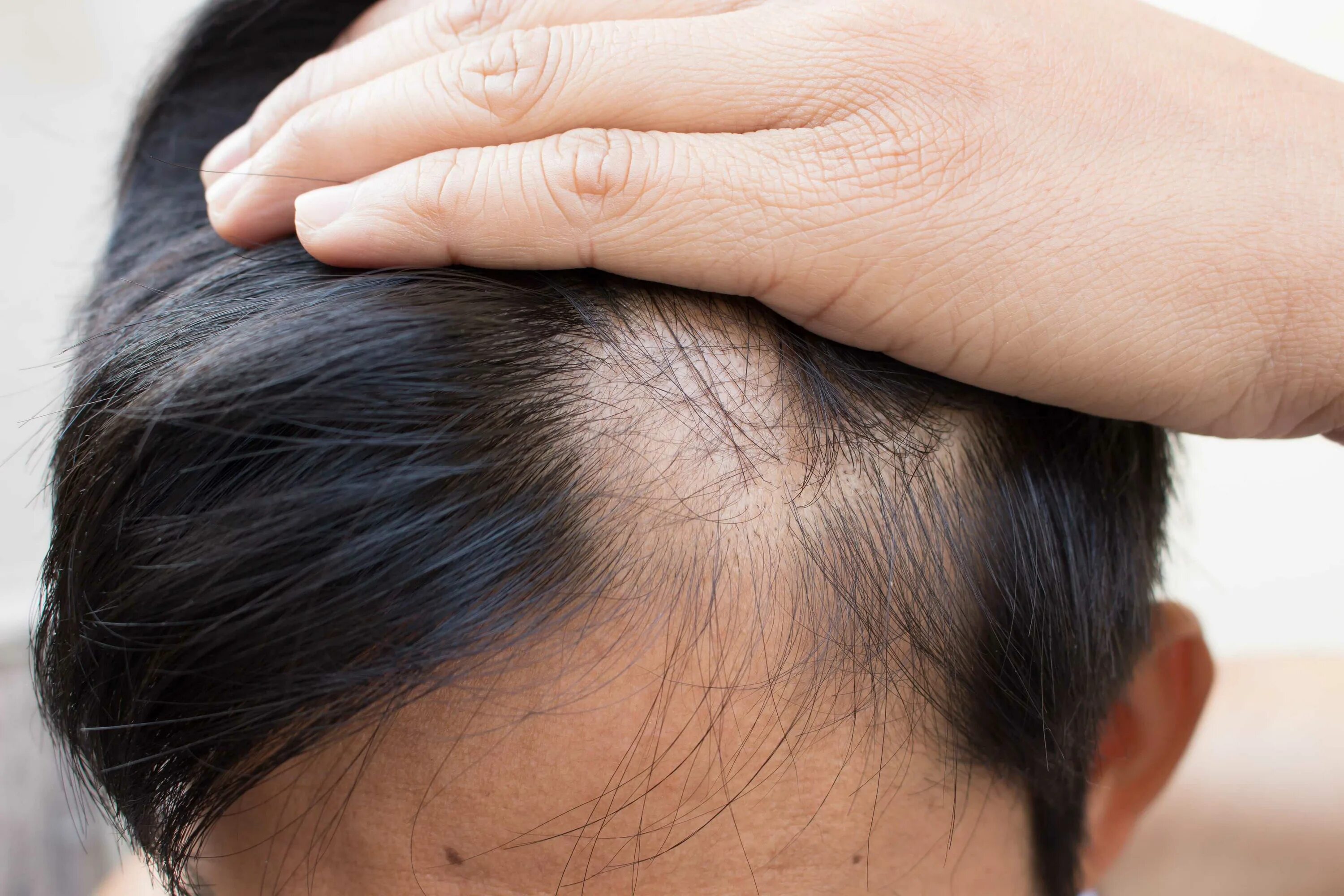 Сильно выпадают волосы на голове лечение. Очаговая алопеция (alopecia Areata). Гнёздная (очаговая алопеция). Очаговая алопеция. Офизиас.