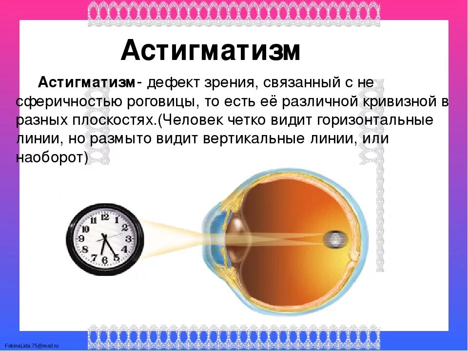 Точка зрения баллы. Астигматическое нарушение зрения. Строение астигматического глаза. Зрение дефекты зрения. Дефекты зрения человека.