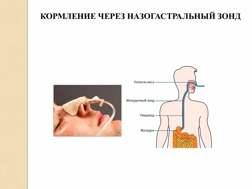 Зонд в нос. Назогастральный зонд. Желудочный зонд назогастральный. Введение пищи через зонд. Искусственное питание зонд.