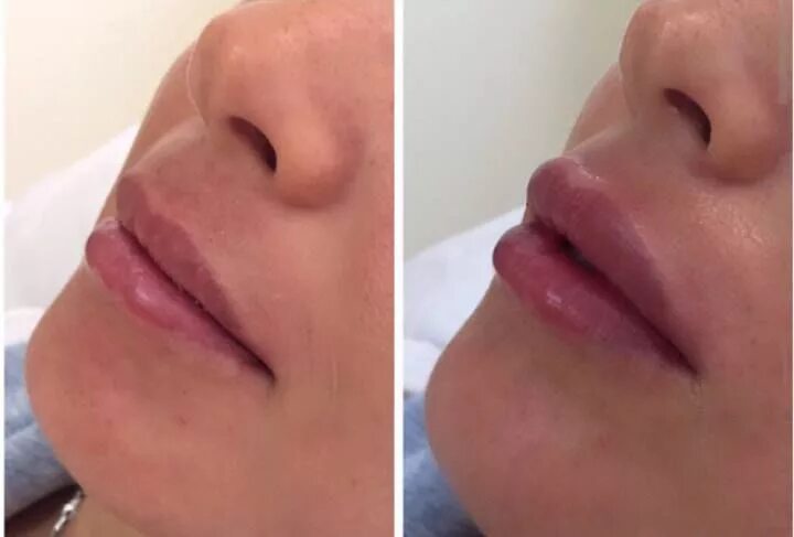 6. 1мл гиалуронка в губы 1 мл гиалуронка. Belotero интенс контурная пластика губ. 6. Белотеро липс шейп филлер для губ.