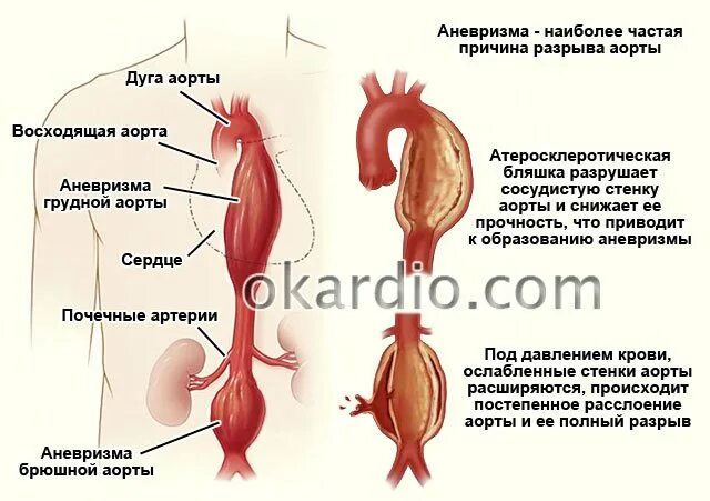 Почему в аорте