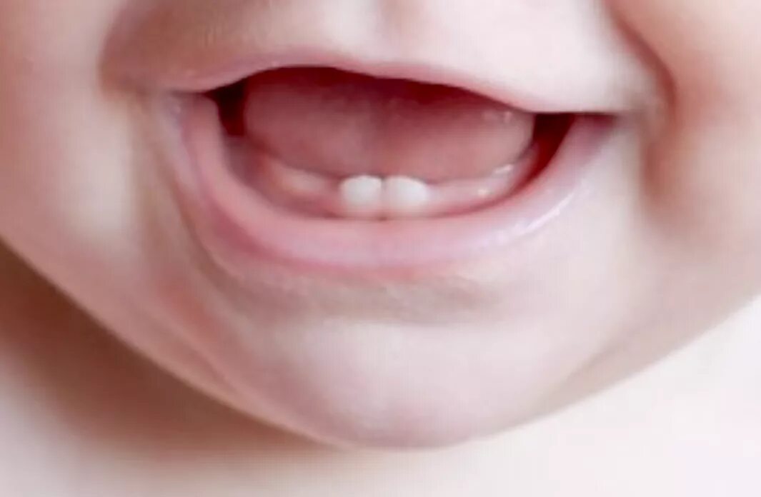 Прорезывание 8 зуба у детей. Прорезывание нижних зубов.