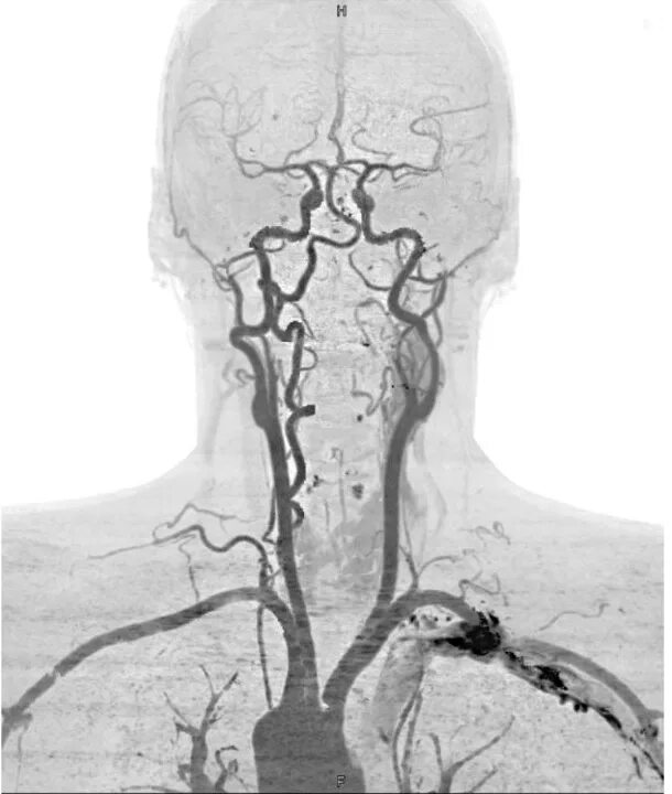 Сосуды головного мозга норма. Ангиограмма сонной артерии. Ангиография сонных артерий. Атеросклероз сосудов головного мозга ангиография.