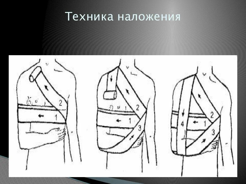 Плечевая повязка алгоритм. Десмургия повязка Дезо. Технику наложения повязки Дезо.. Повязка Дезо техника наложения. Наложение повязки Дезо алгоритм.