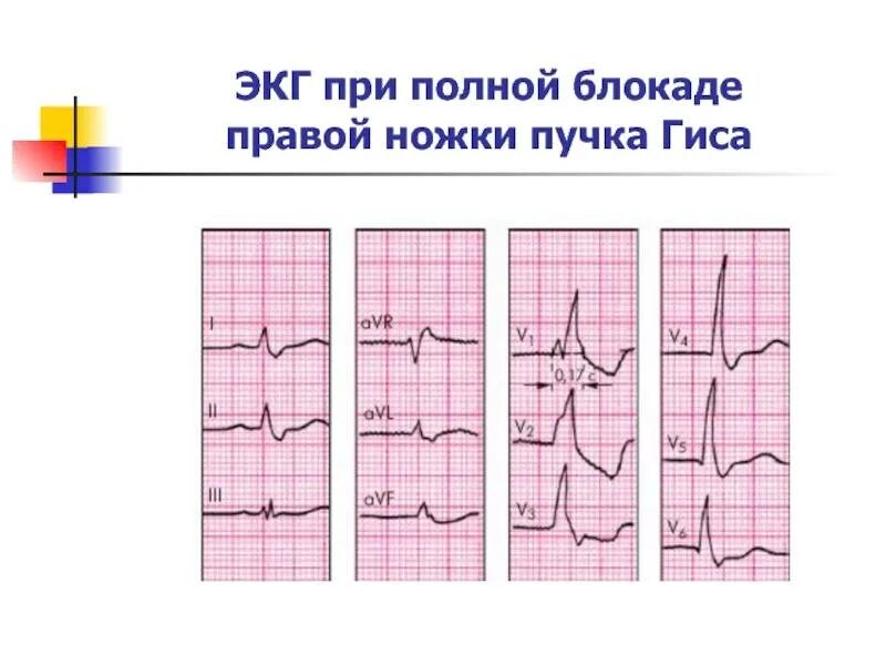 Замедление проведения по правой ножке пучка. Экг при блокаде правой и левой ножки пучка гиса. неполная блокада левой ножки пучка гиса на экг. блокада лнпг на экг. экг при неполной блокаде пнпг.