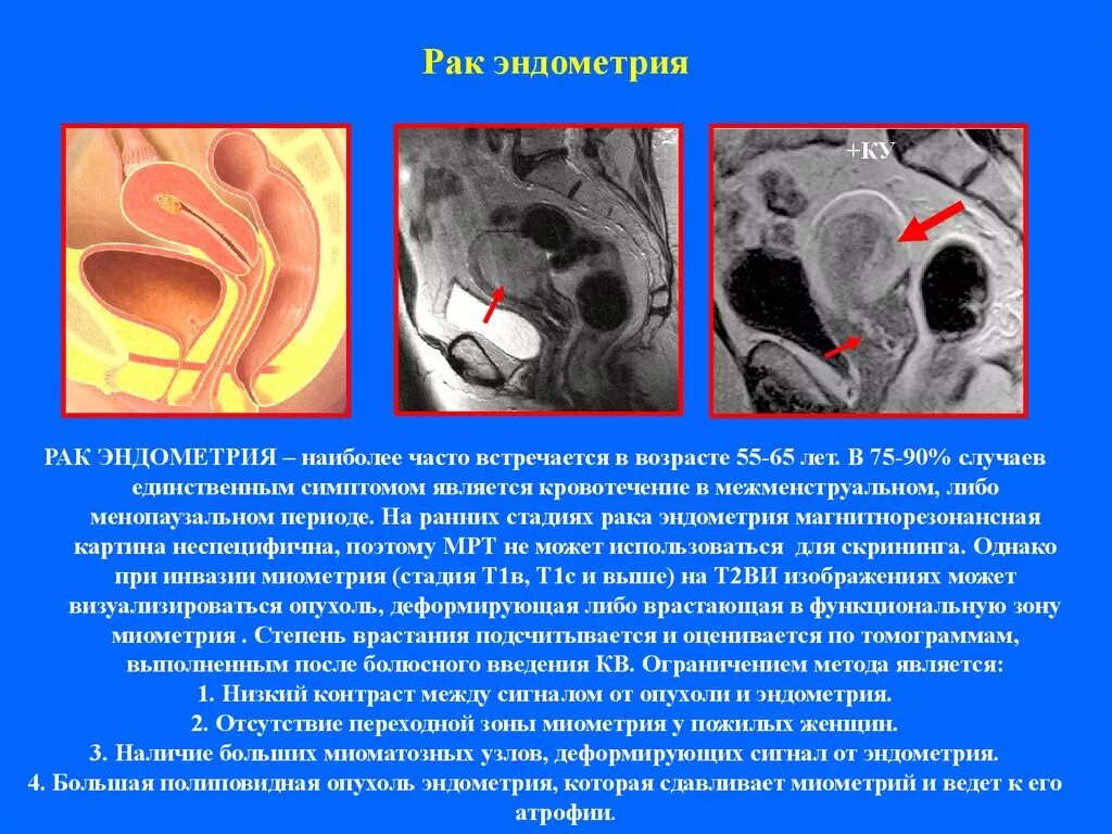 Эндометрий 30. Опухоль эндометрия мрт. Образования тела матки мрт. Патология эндометрия мрт.