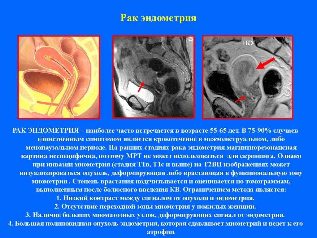 Симптомы рака эндометрия