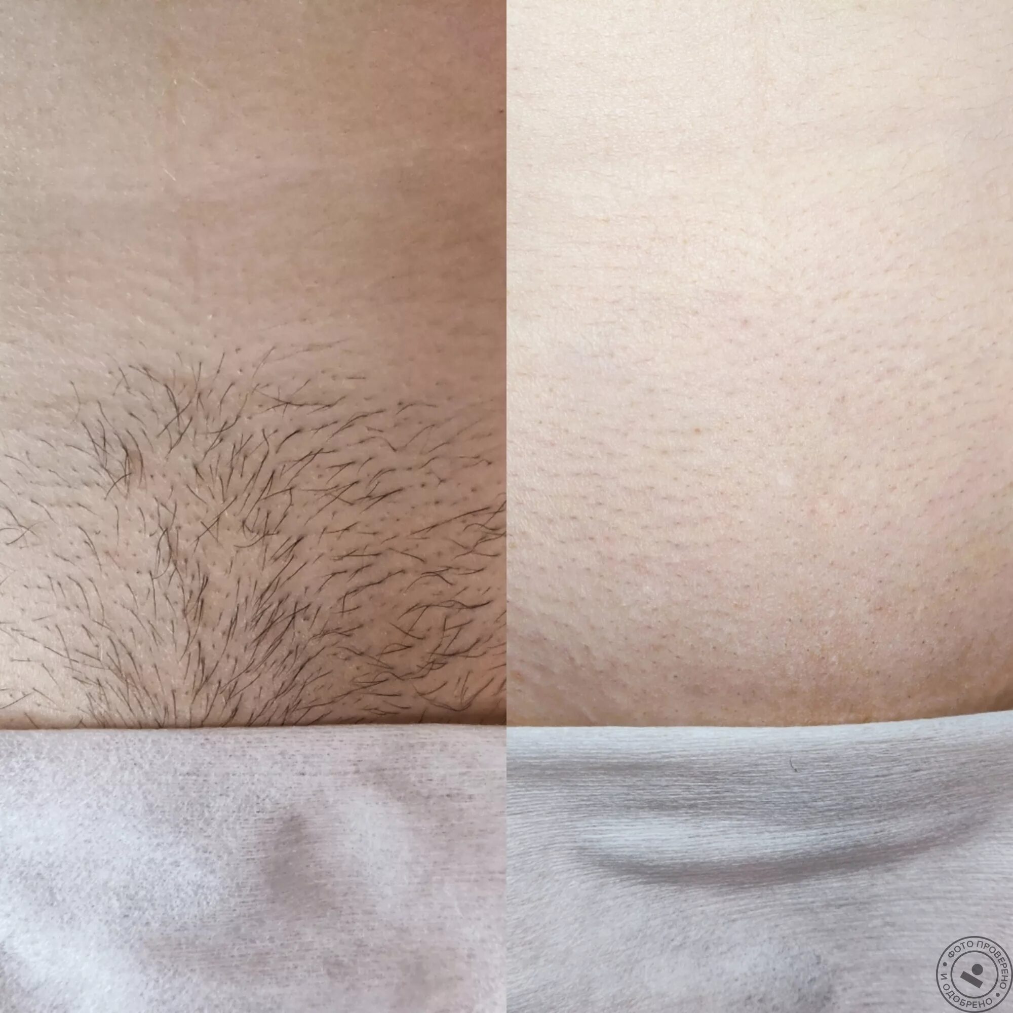 Стрижки депиляции. Салон красоты лазерная эпиляция. Стрижки депиляции. Шугаринг. Восковая депиляция.