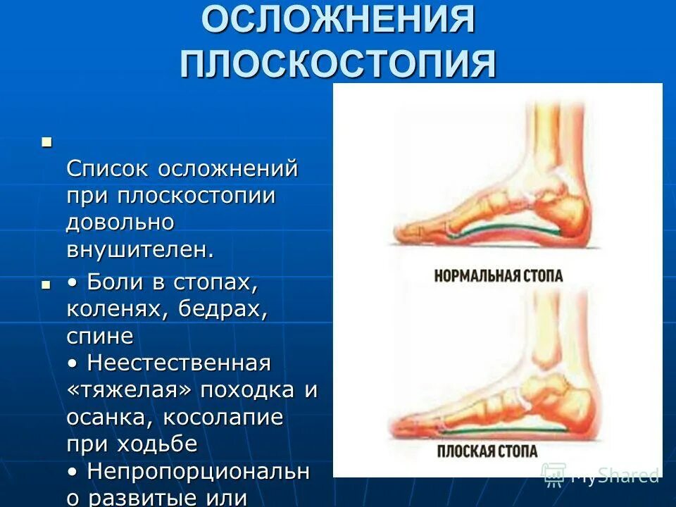 Плоскостопие. Последствия плоскостопия. Осложнения плоскостопия. Осложнения плоскостопия у детей.