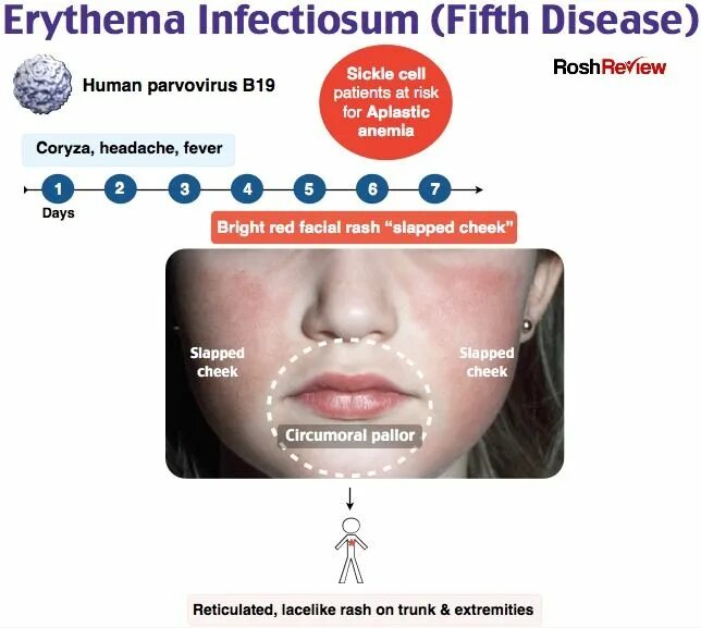 Парвовирус у детей лечение. Инфекционно аллергическая эритема. Парвовирусная инфекция у детей. Инфекционная эритема парвовирус.