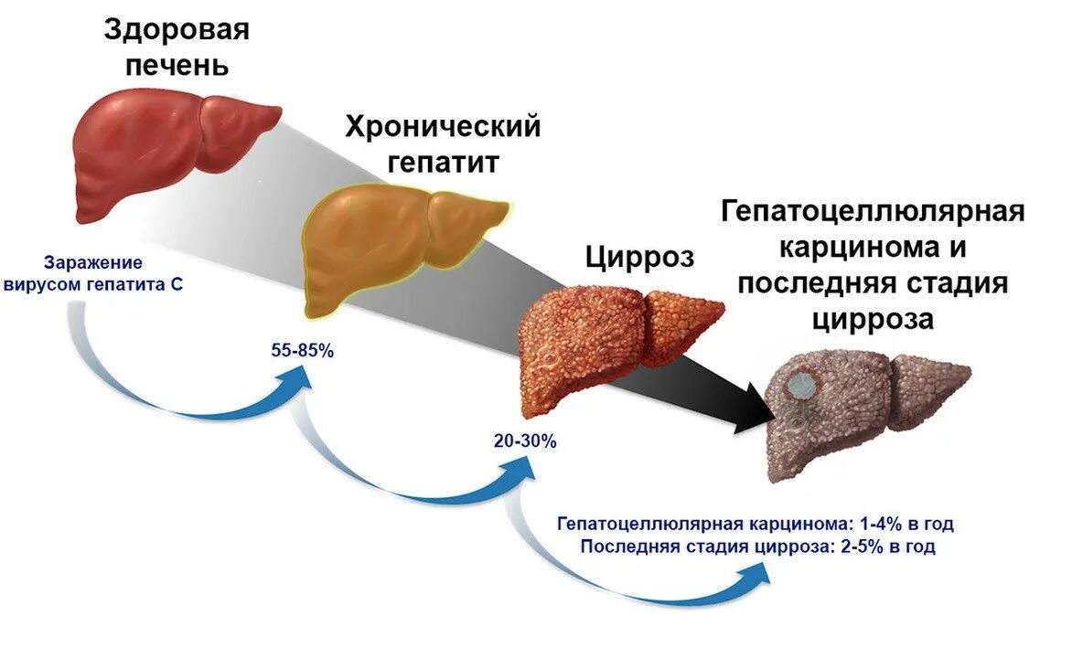 Повышенная печень что означает. Хронический вирусный гепатит с цирроз печени. Хронический гепатит б цирроз печени. Цирроз печени и вирусный гепатит b.