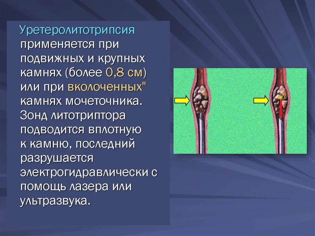 Заболевания мочеточника. Пластика мочеточника по Боари. Уретеролитотрипсия камень в мочеточнике.