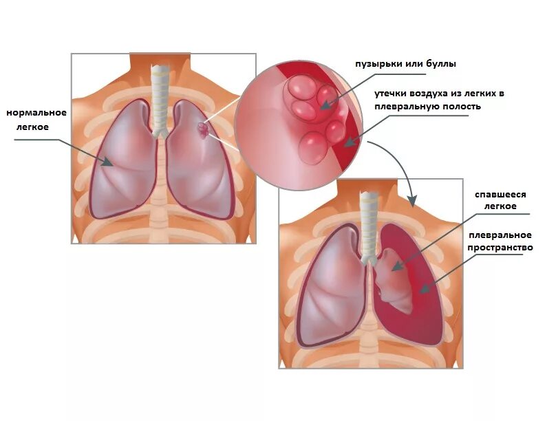 Попадание воздуха в полость. Буллезная болезнь легких пневмоторакс. Буллы при пневмотораксе. ХОБЛ спонтанный пневмоторакс. Буллезная эмфизема лёгких.