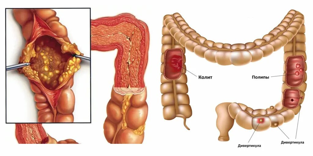 Колит симптомы у взрослых мужчин. Язвини колить толскишка. Хронические воспалительные заболевания кишечника язвенный колит. Клостридиальный колит.