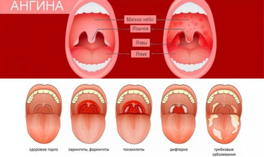 Тонзиллиты фарингиты ларингиты. Различия тонзиллита и фарингита ларингита и ангины. Катаральное воспаление миндалин. Сыпь температура боль в горле у ребенка
