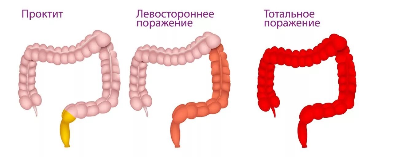 Лечение проктита прямой. Проктит - воспаление слизистой оболочки прямой кишки.. Язвенный колит проктит.