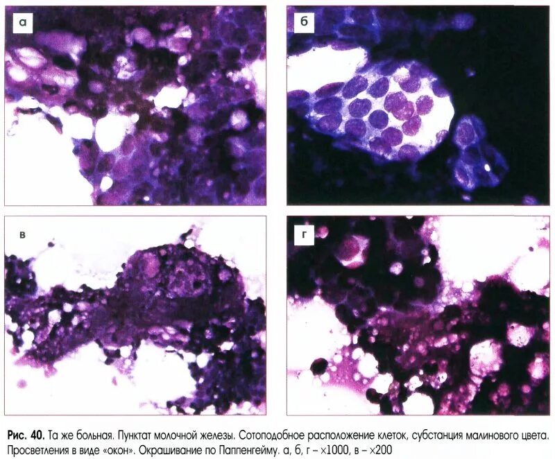 Цитологическое исследование пунктата. Цитологическое исследование пунктата опухоли молочной железы. Цитологическое исследование кисты молочной железы. Гистология гистология пролиферативная мастопатия молочной. Цитология пунктата кисты молочной железы.