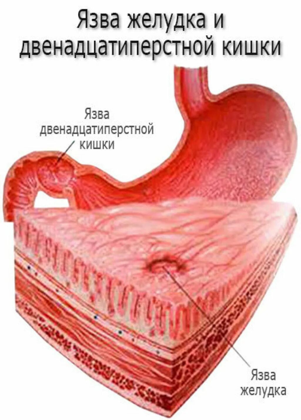Язвенная болезнь желудка и 12 перстной. Язвенная болезнь желудка и 12 перстной кишки. Язвенная болезнь болезнь желудка и 12 перстной кишки. Язвенная болезнь 12 перстной кишки. Язвенный латынь