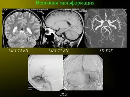 Венозная мальформация мкб